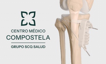 ¿Cómo puedo tratar el dolor de la artrosis sin una prótesis?